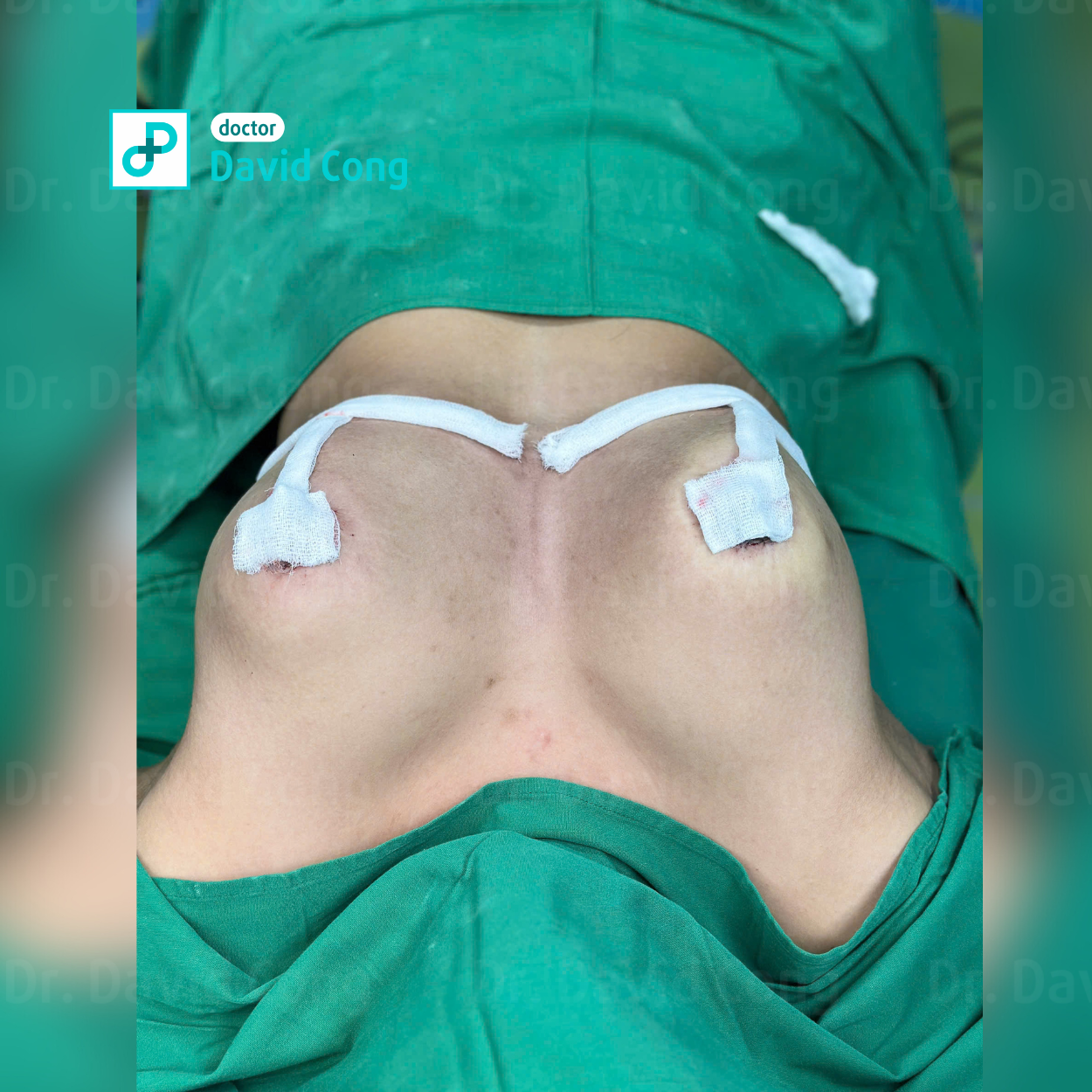 image about breast augmentation at dr david cong