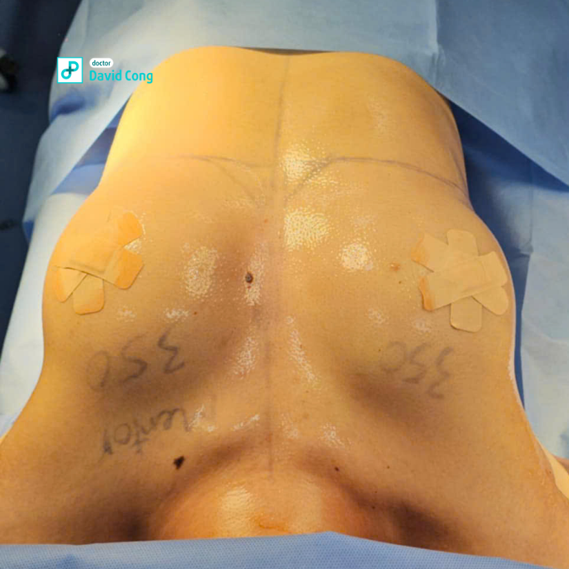 before and after breast augmentation at dr david cong