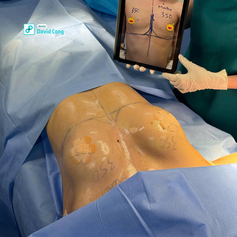 before and after breast augmentation at dr david cong