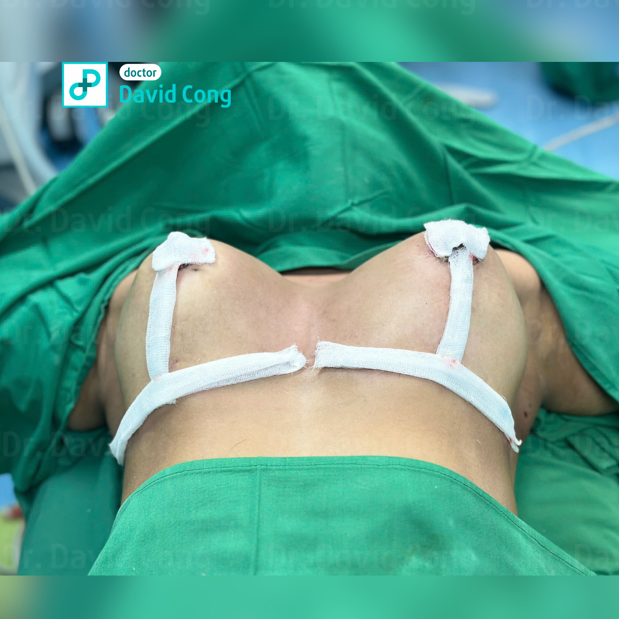 image about breast augmentation at dr david cong