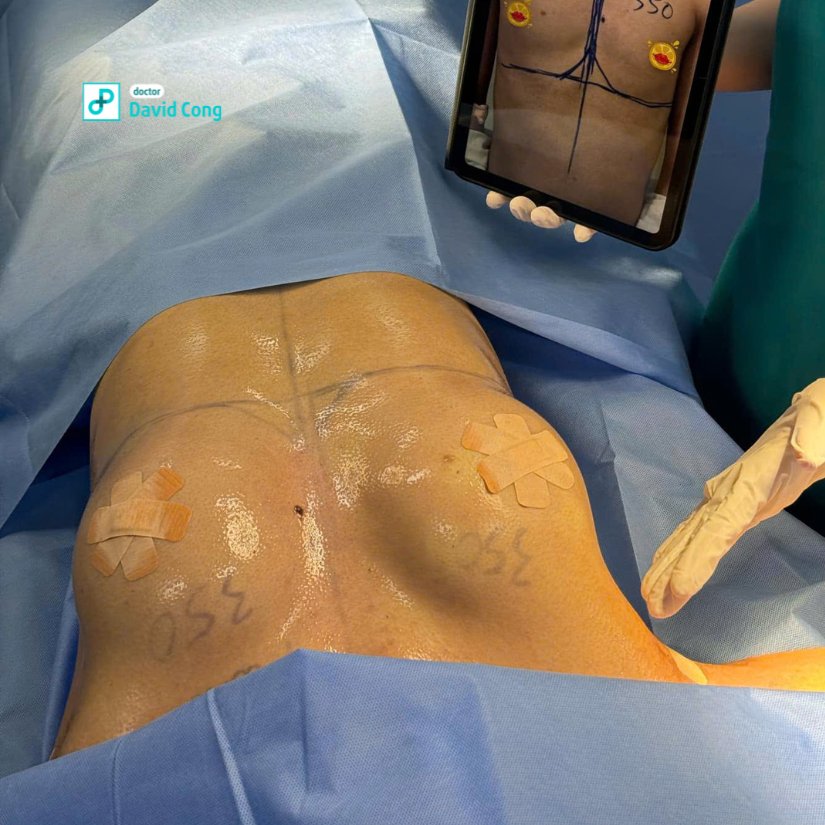 before and after breast augmentation at dr david cong
