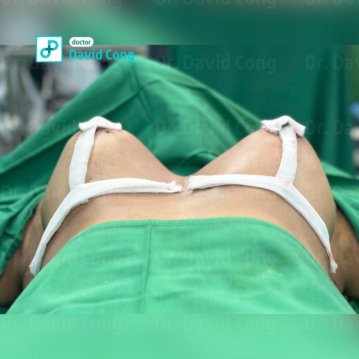 image about breast augmentation at dr david cong