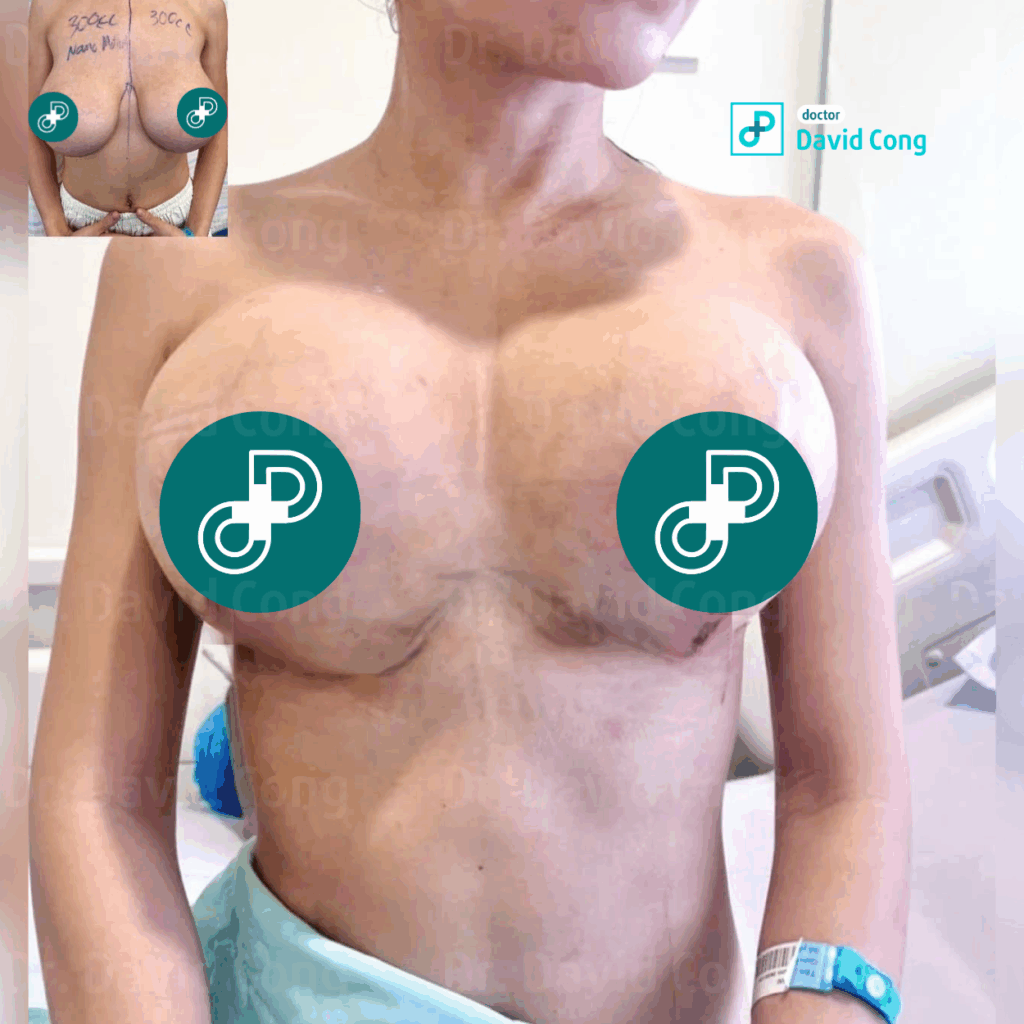 image of after breast lift at dr david cong