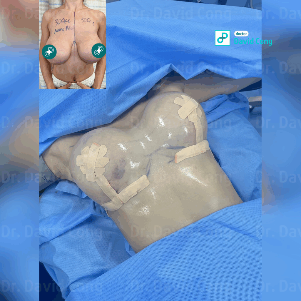 image of after breast lift at dr david cong