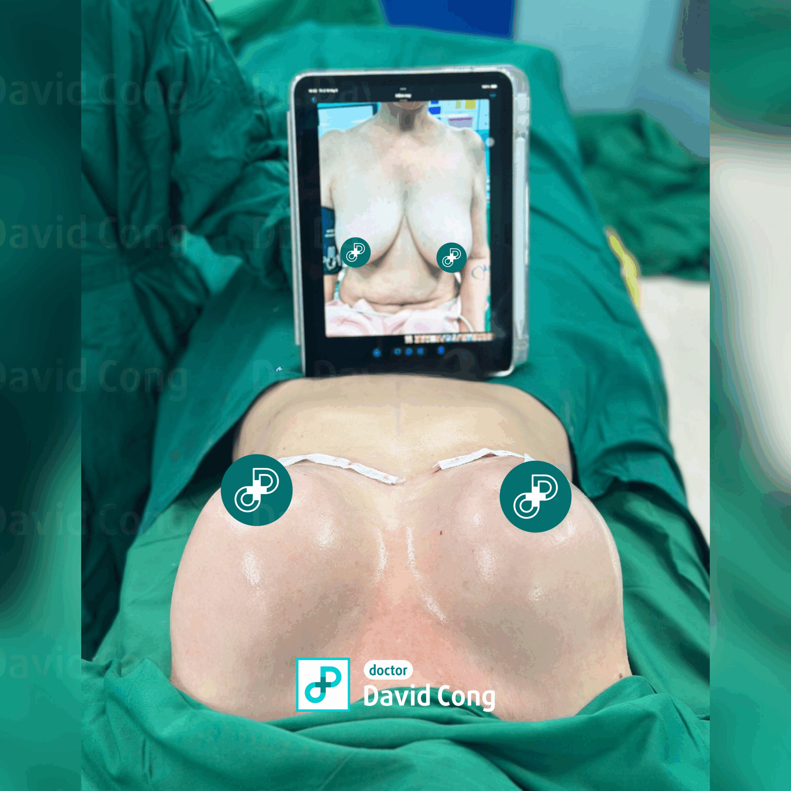 breast after lifting at dr david cong