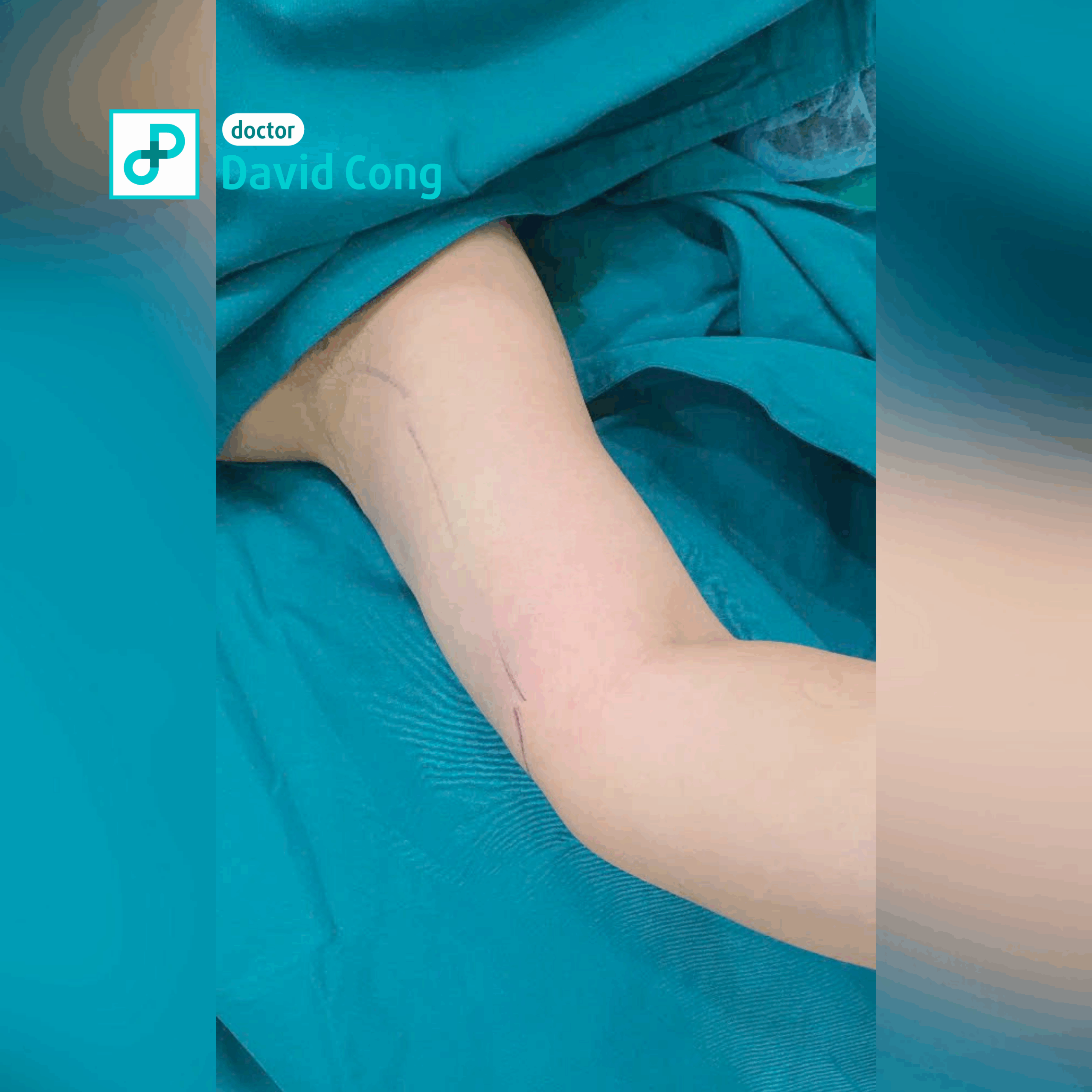 image of after liposuction at dr david cong