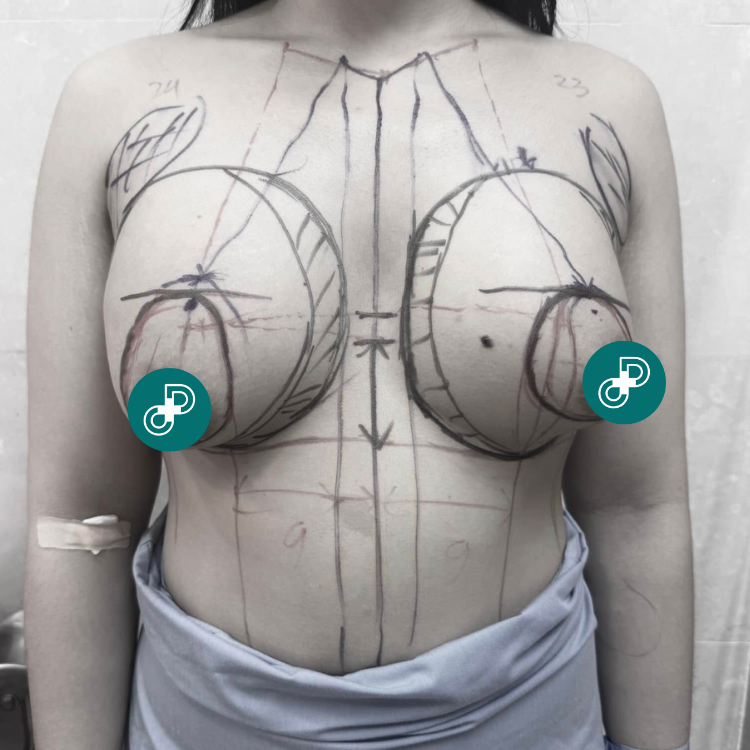 before and after breast lift at dr david cong
