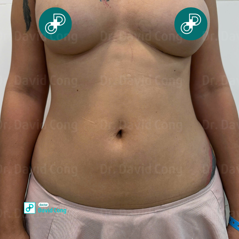 after and before lipo360 at dr david cong