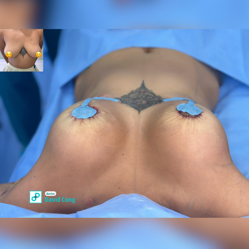 before and after breast lift at dr david cong