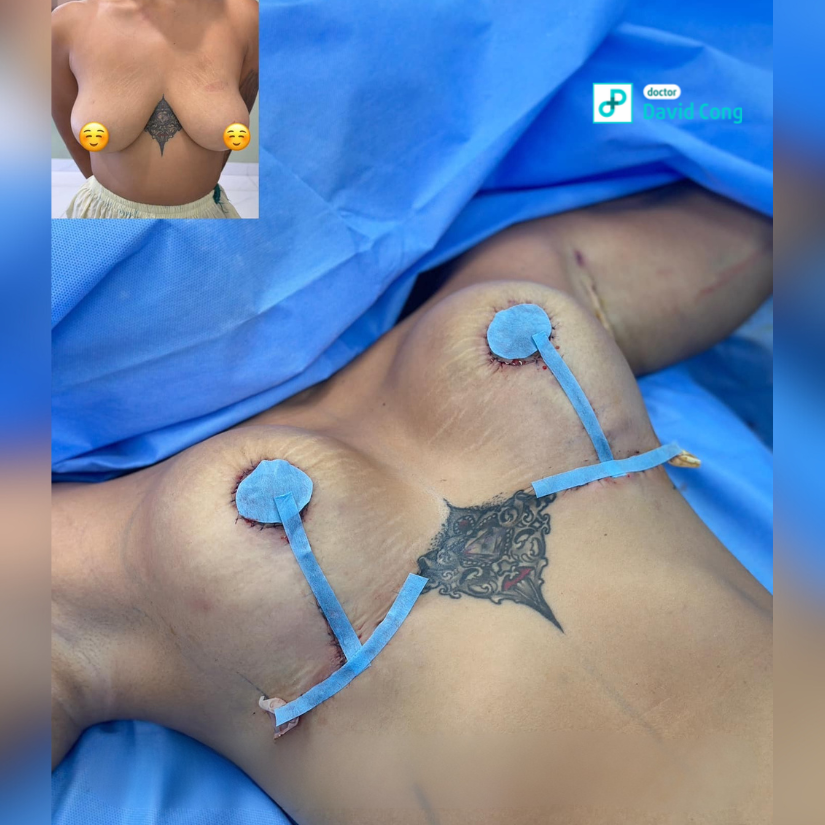 before and after breast lift at dr david cong