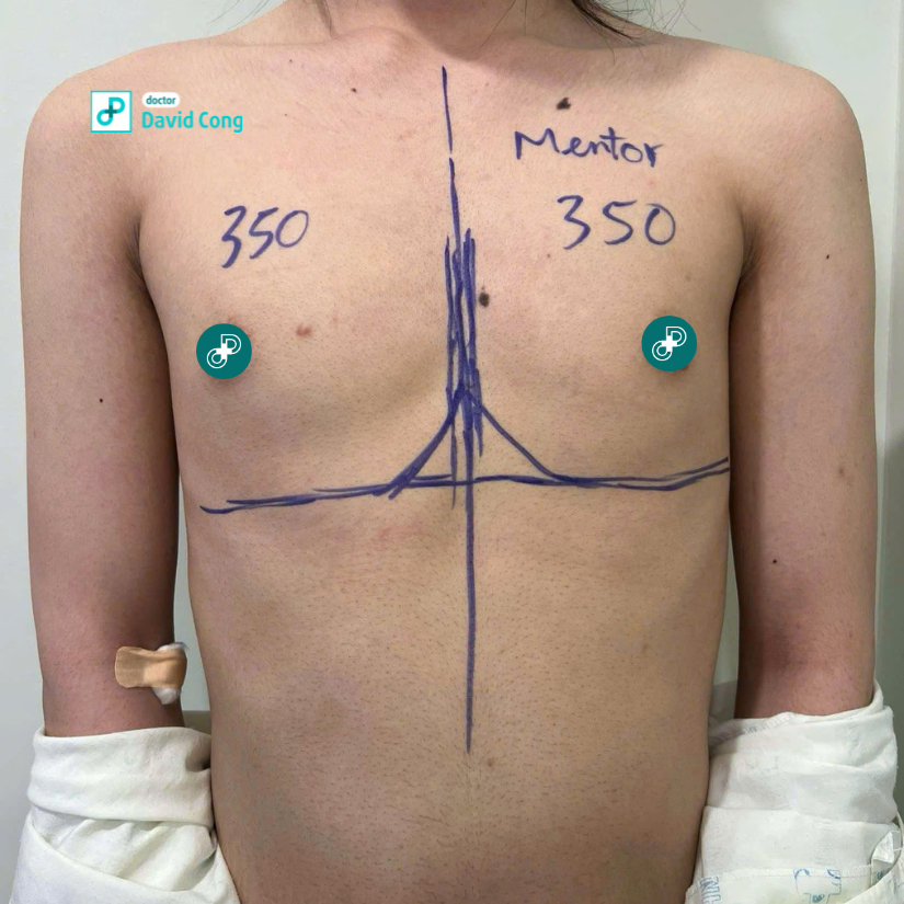 before and after breast augmentation at dr david cong