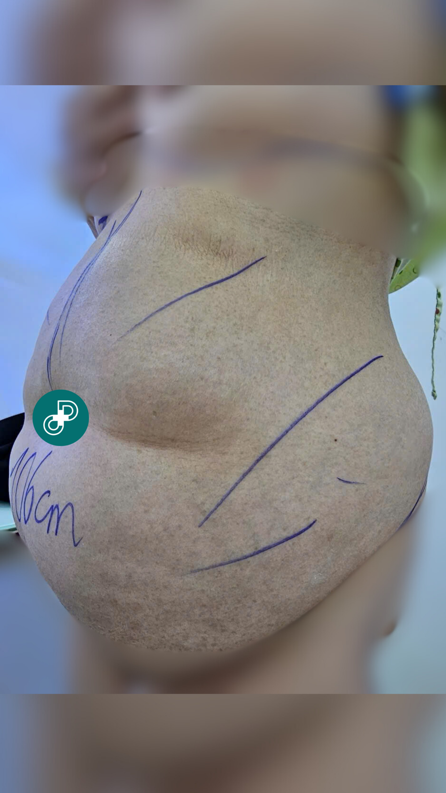 image of before liposuction and tummy tuck at dr david cong
