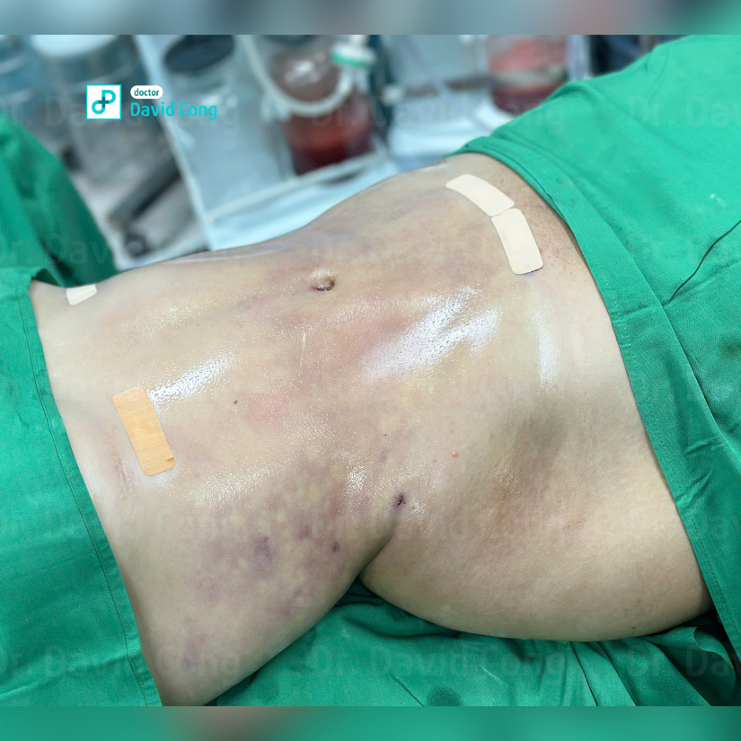 after and before lipo360 at dr david cong
