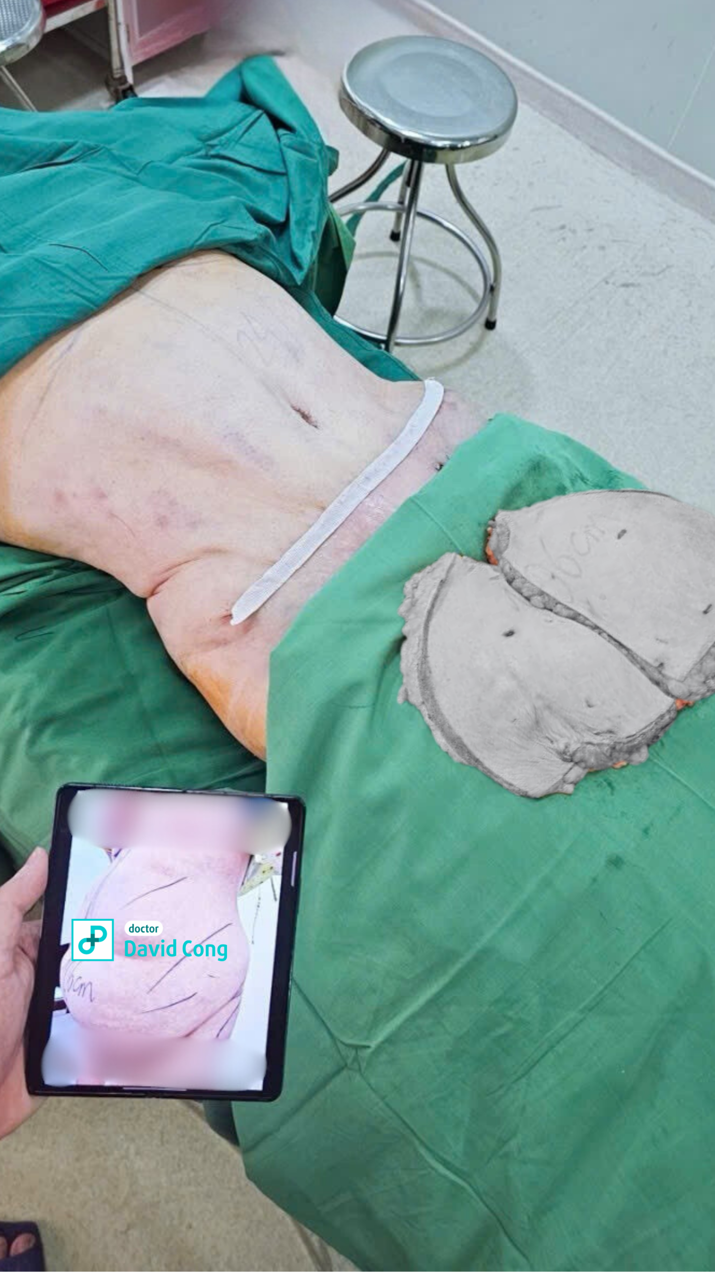 image of before and after liposuction and tummy tuck at dr david cong