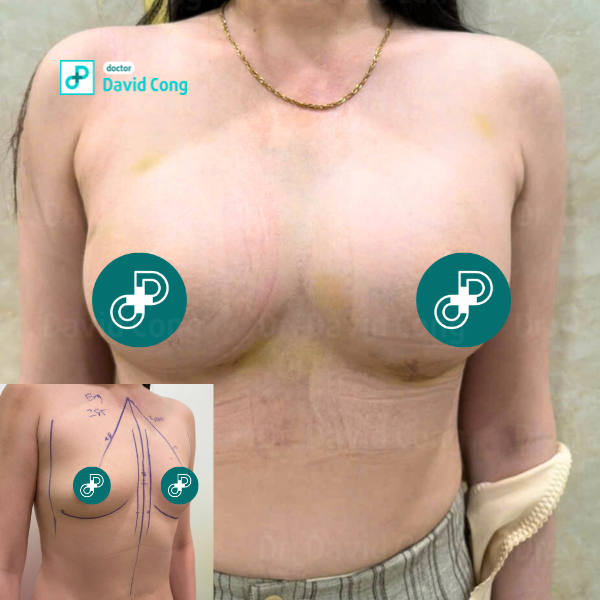 after breast augmentation at dr david cong