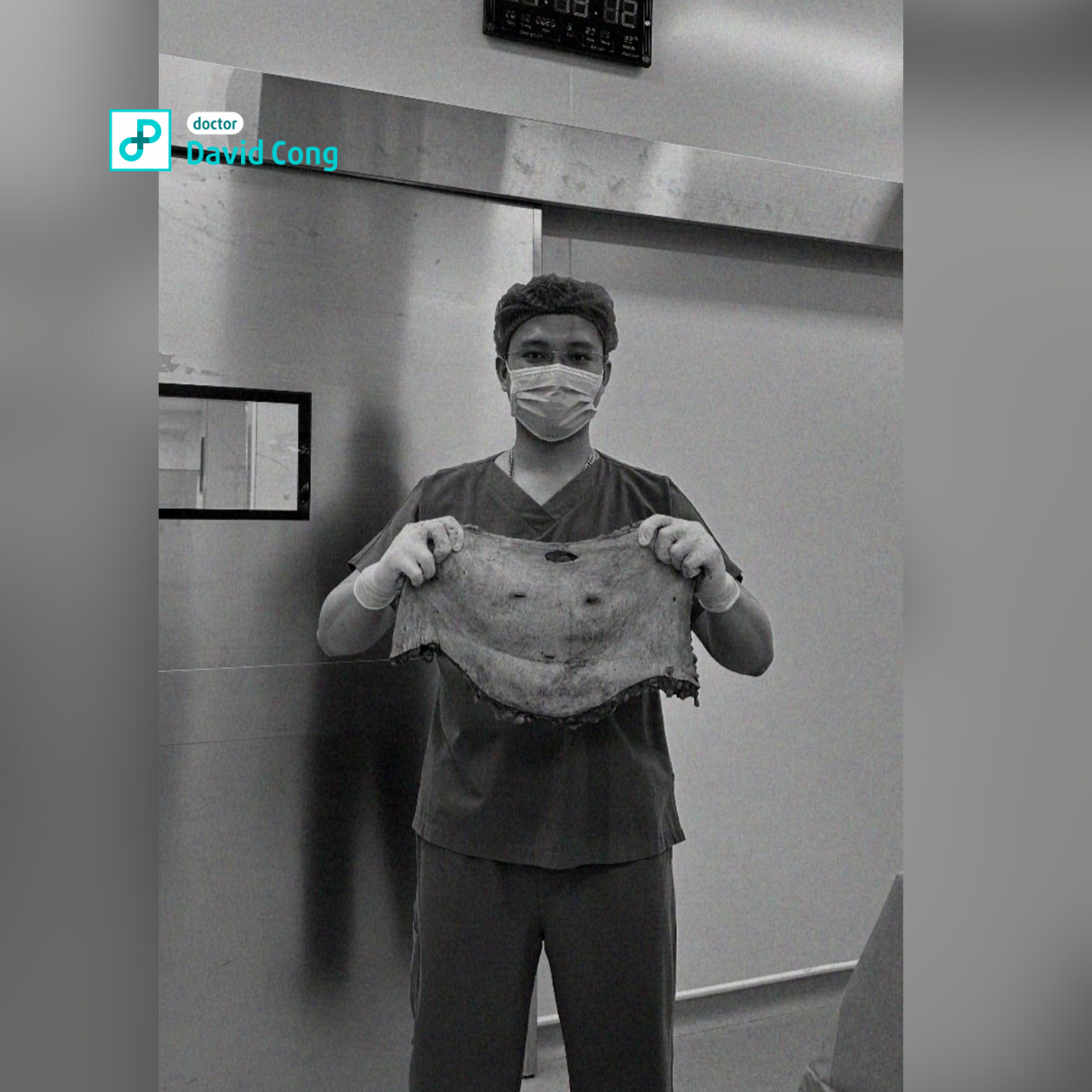 tummy tuck procedure dr david-cong