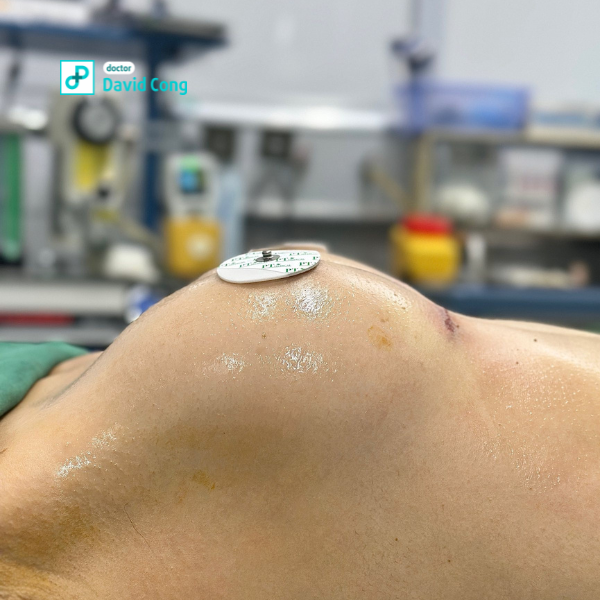 before breast augmentation at dr david cong