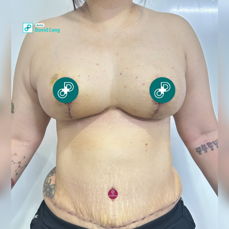 mommy makeover at Dr David Cong