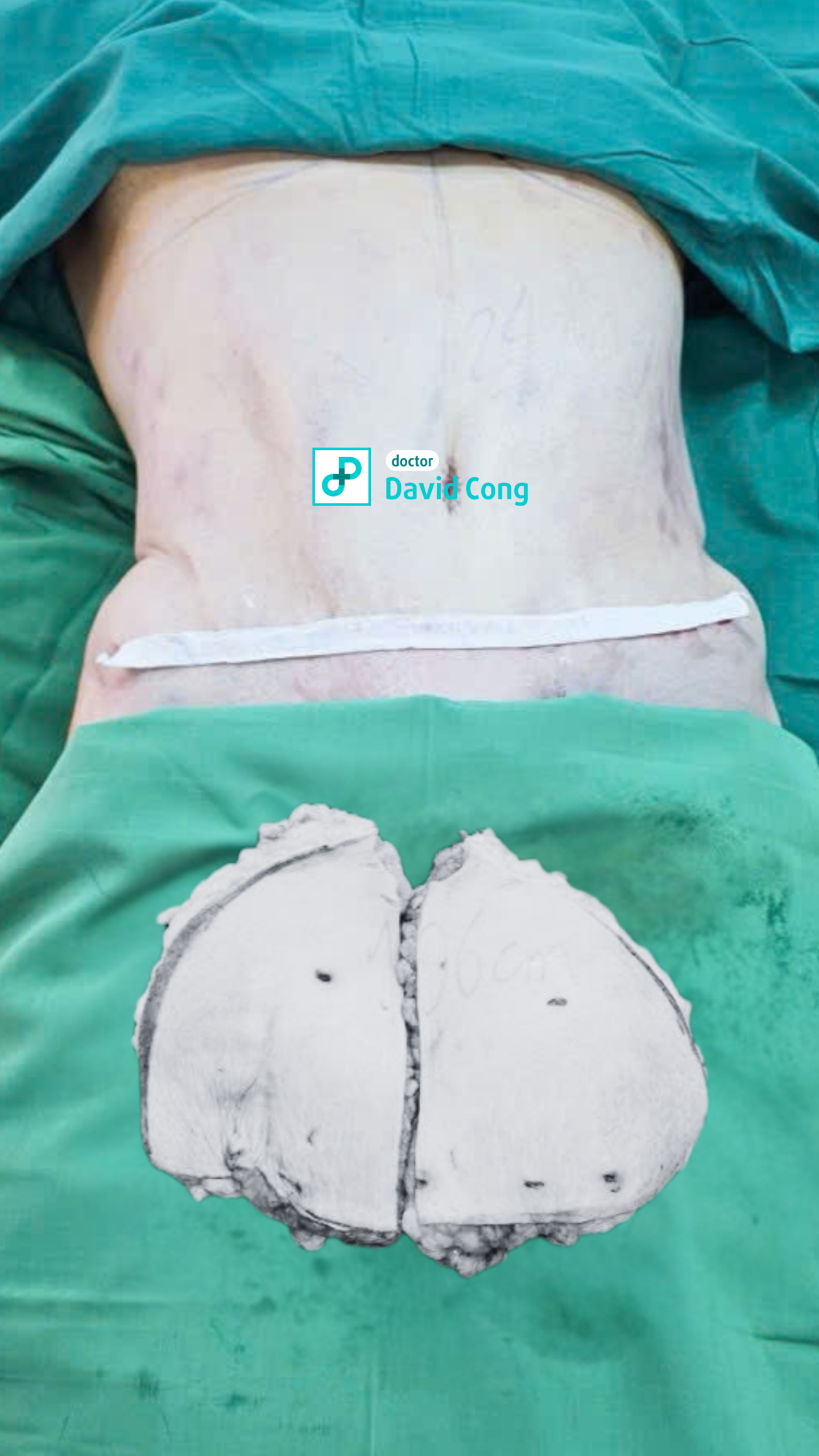 image of before and after liposuction and tummy tuck at dr david cong