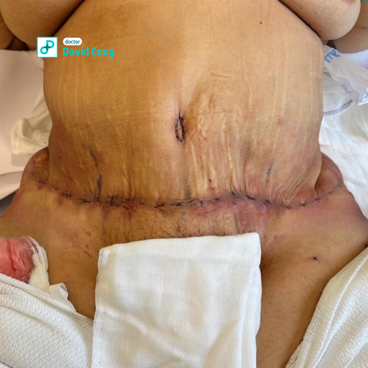 after tummy tuck procedure dr david-cong