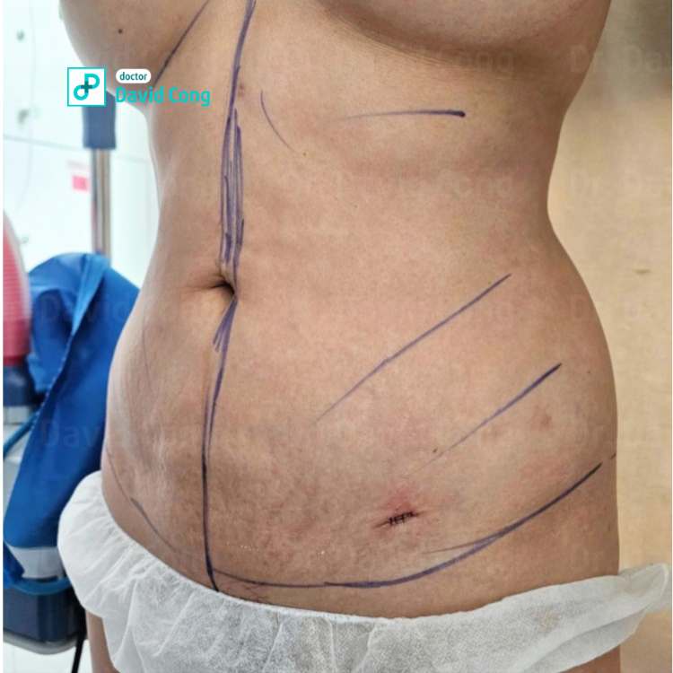 after and before lipo360 at dr david cong
