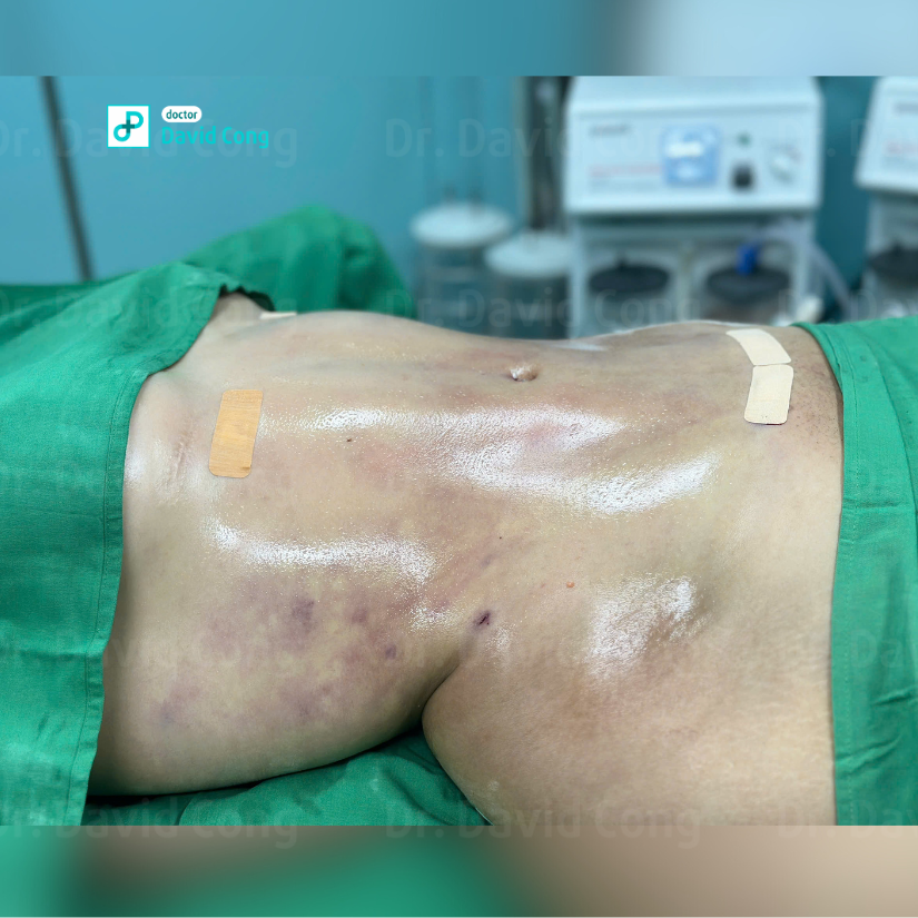 after and before lipo360 at dr david cong