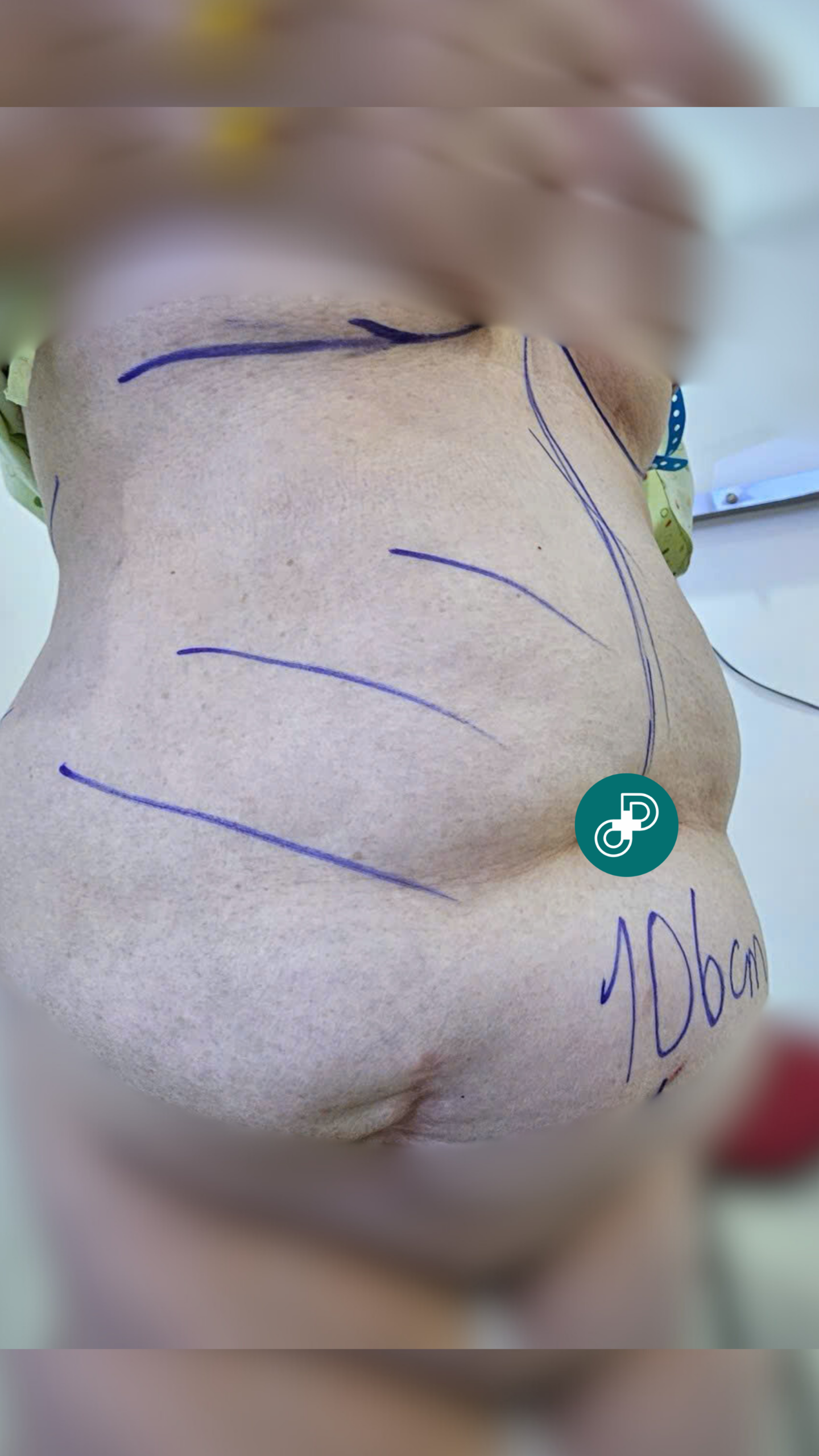 image of before liposuction and tummy tuck at dr david cong
