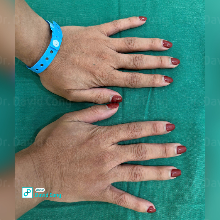 $$\text{Before and After Hand and Foot Rejuvenation at Dr. David Cong's Clinic}$$