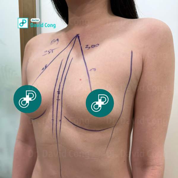 before breast augmentation at dr david cong