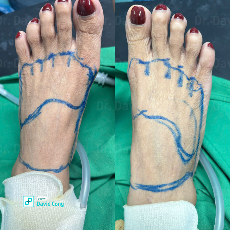 $$\text{Before and After Hand and Foot Rejuvenation at Dr. David Cong's Clinic}$$