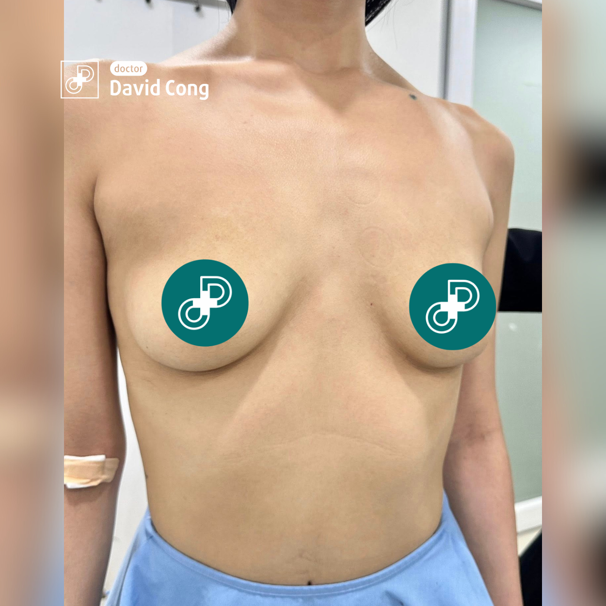 image of before breast augmentation at dr david cong