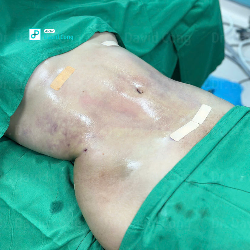 after and before lipo360 at dr david cong