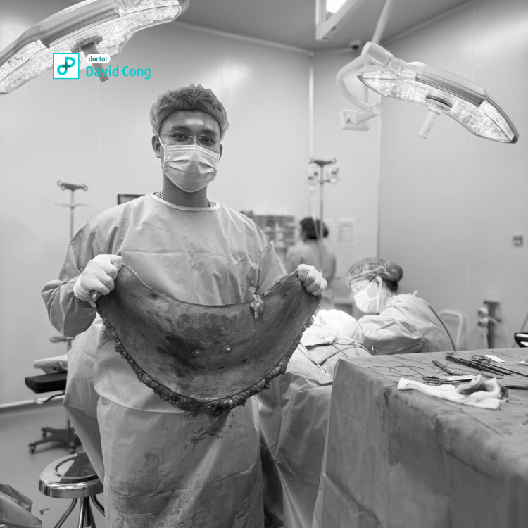 after and before tummytuck at dr david cong