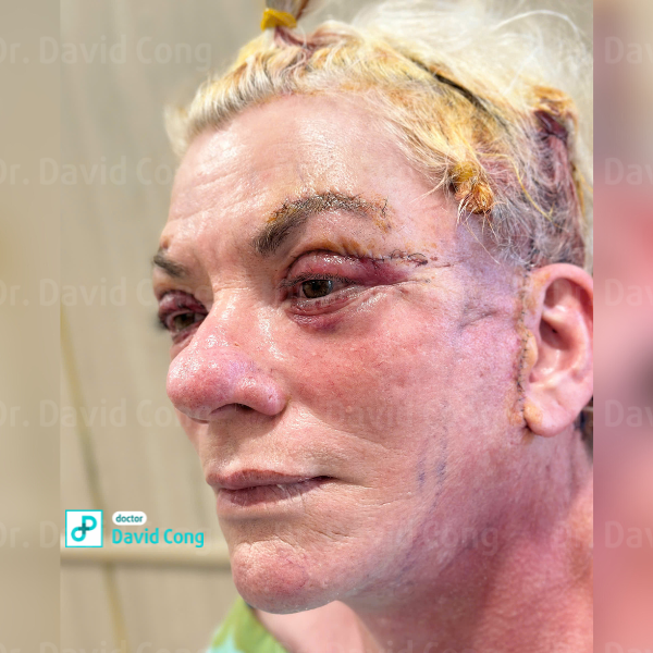 after facelift at dr david cong