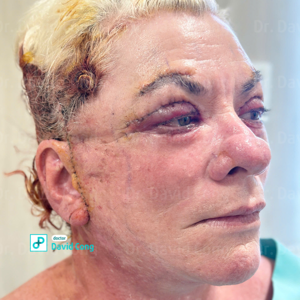 after facelift at dr david cong