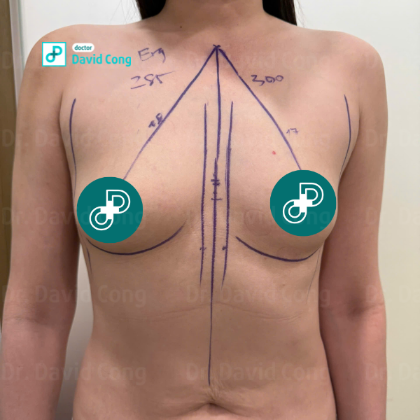 before breast augmentation at dr david cong