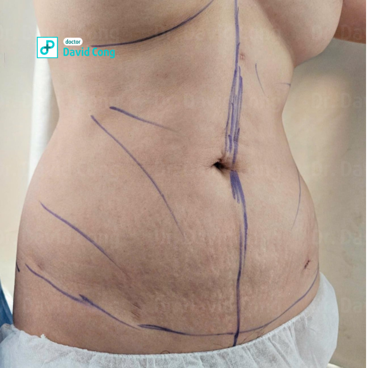 after and before lipo360 at dr david cong

