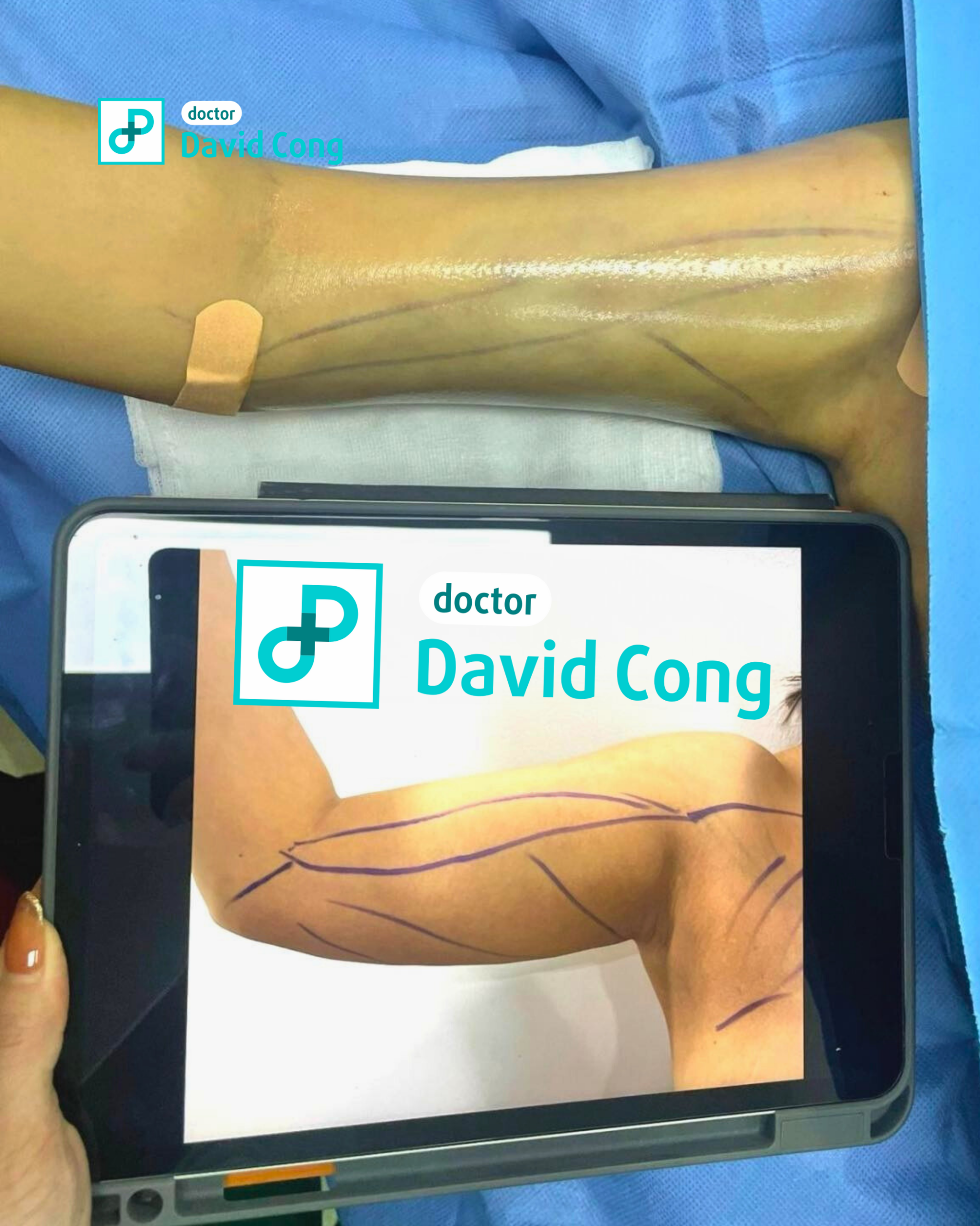 image of before and after liposuction at dr david cong
