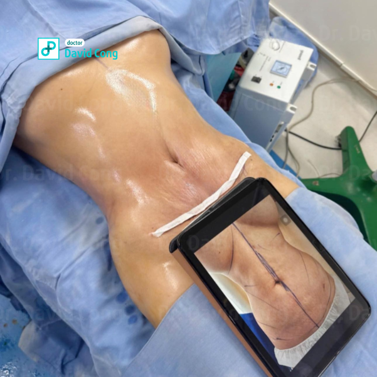 after and before lipo360 at dr david cong