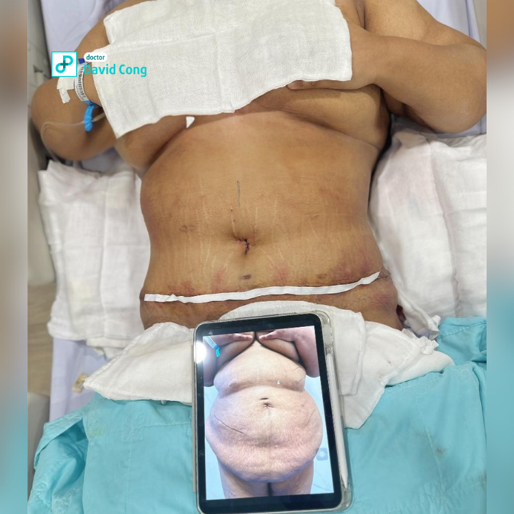 after and before tummytuck at dr david cong