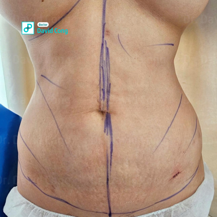after and before lipo360 at dr david cong
