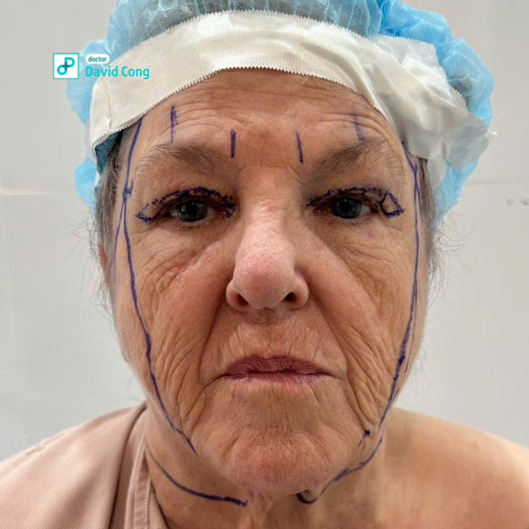 before and after facelifting at dr david cong
