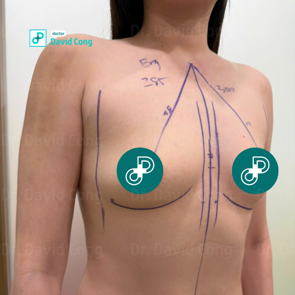 before breast augmentation at dr david cong