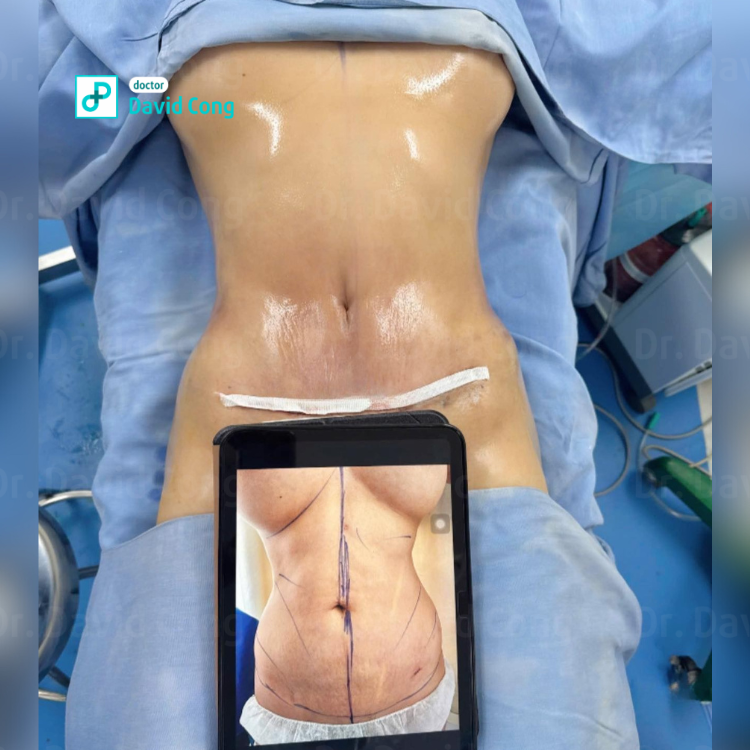 after and before lipo360 at dr david cong