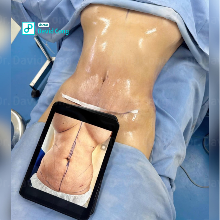 after and before lipo360 at dr david cong
