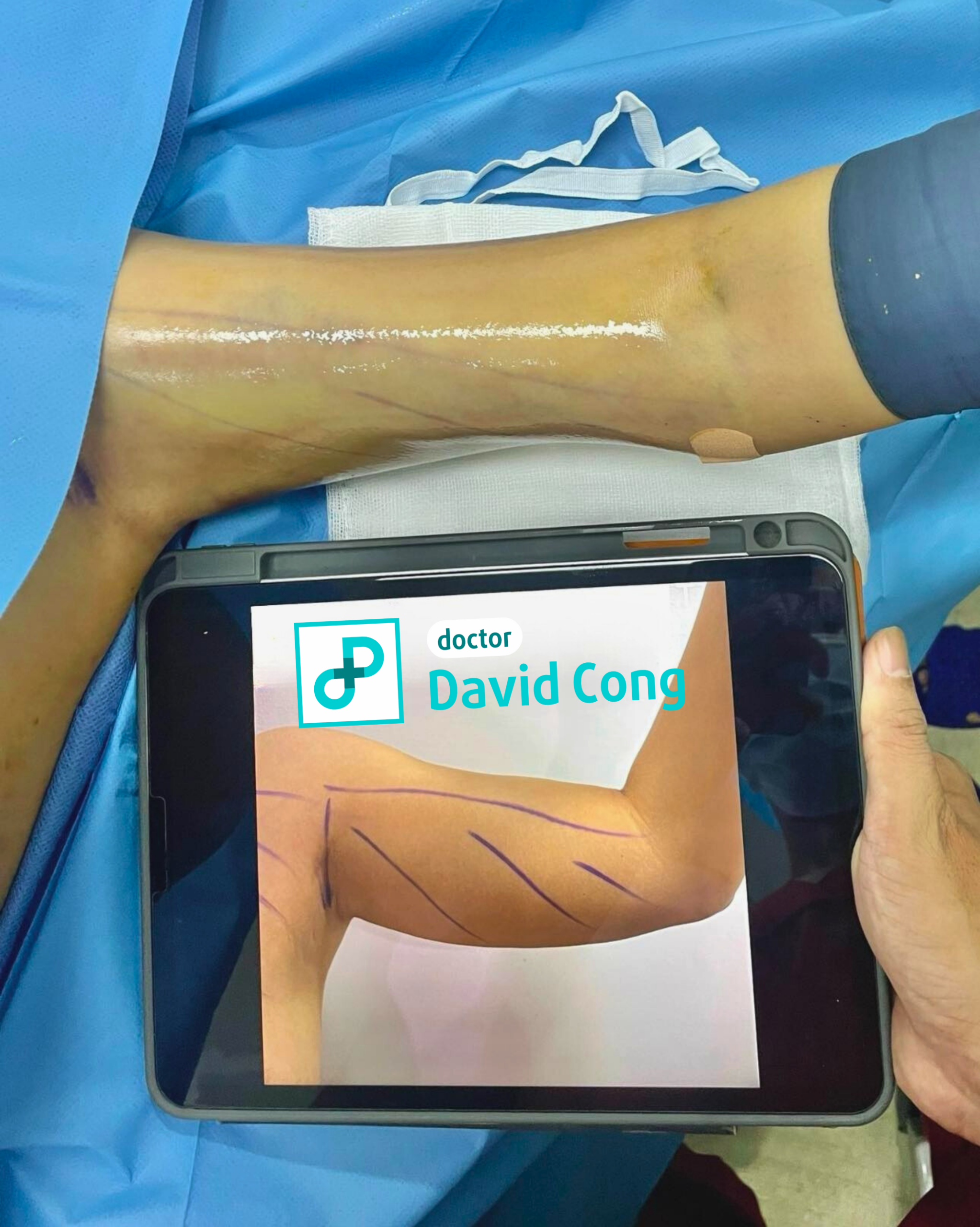 image of before and after liposuction at dr david cong
