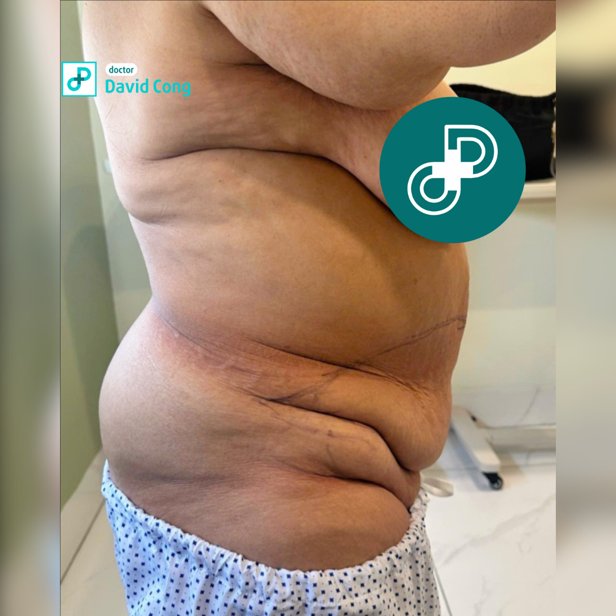  before liposuction procedure dr david-cong