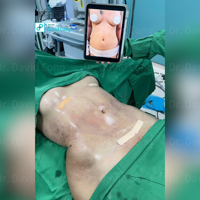 after and before lipo360 at dr david cong