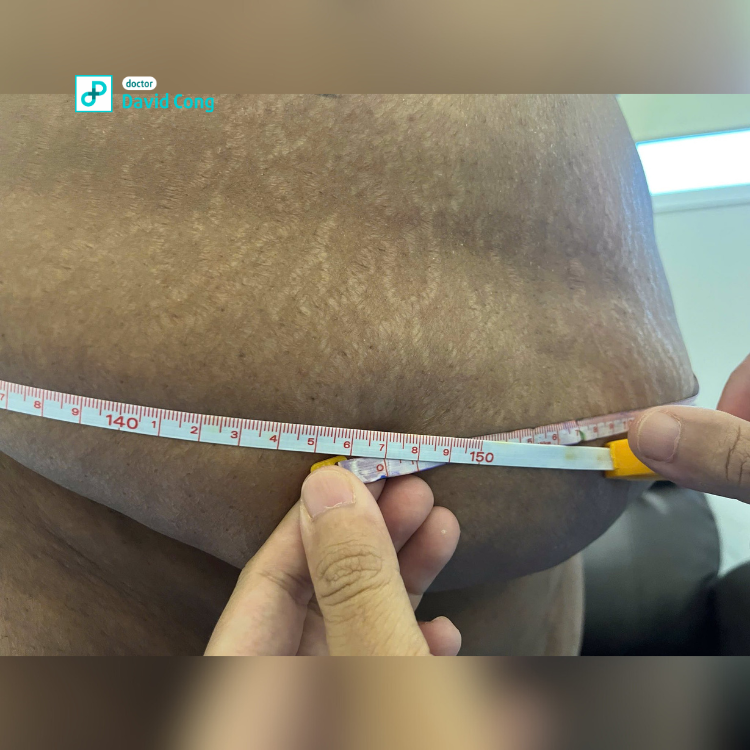 after and before tummytuck at dr david cong
