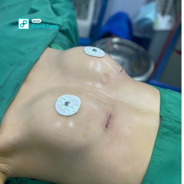 before breast augmentation at dr david cong